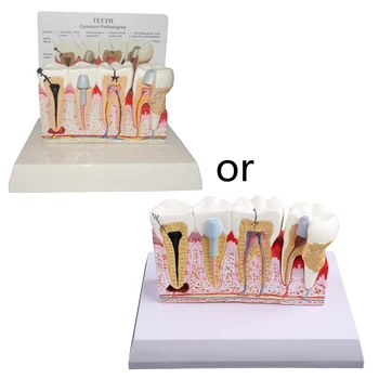 Обучающая и поясняющая модель пациента для изучения кариеса зубов Модель Челнока